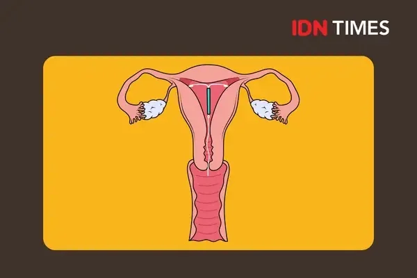 7 Tanda IUD Harus Segera Dilepas, Jangan Ditunda-tunda!