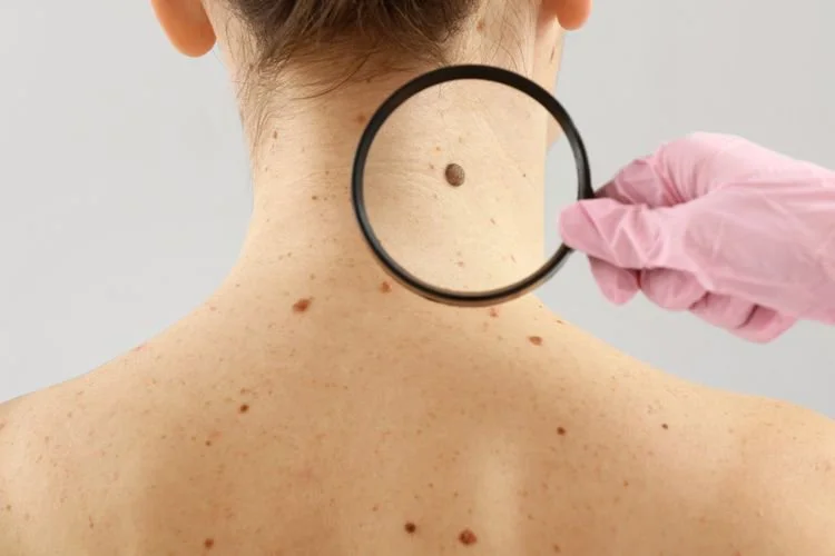 Ilustrasi kanker kulit melanoma. Studi yang sering dikutip untuk menyebut sunscreen menyebabkan kanker ternyata tidak menyimpulkan hal tersebut.