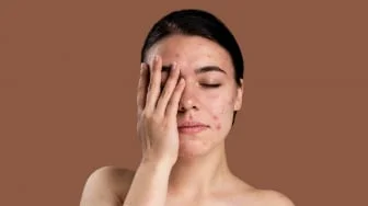 Sunscreen Apa yang Bisa Menghilangkan Bekas Jerawat? Ini 7 Rekomendasi sesuai Review dan Harga