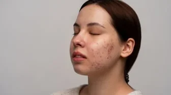Sunscreen Apa yang Bisa Menghilangkan Bruntusan? Ini 6 Rekomendasi sesuai Review dan Harga